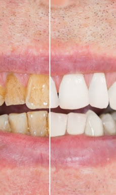 Before and after comparison of a teeth whitening treatment at Chatterjee Oral Care